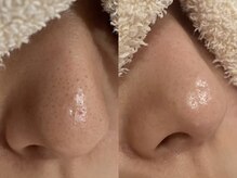 キュアフロウ 橿原店/3回来店☆鼻の黒ずみケア