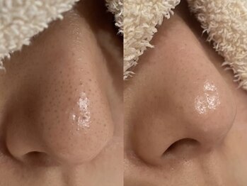 キュアフロウ 橿原店/3回来店☆鼻の黒ずみケア