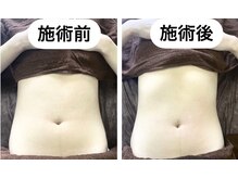 たるみ引き締め即実感・エクシリスで小顔美肌も叶う人気痩身施術