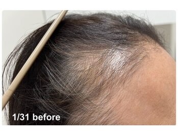 キュライム カブール町田店/2回で生え際に