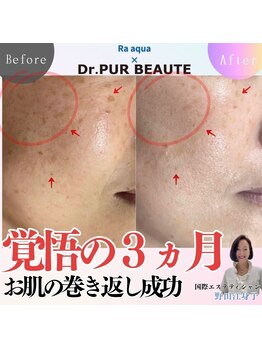 エステティックサロン ラ アクア(ra aqua)/覚悟の3ヵ月人生の巻き戻し成功