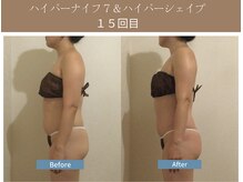 漢方アロマヒーリングサロン 浦和店(漢方AROMAヒーリングサロン)/ハイパーナイフ7＆シェイプ15回