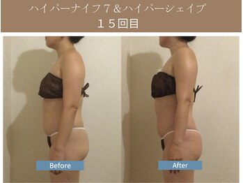漢方アロマヒーリングサロン 浦和店(漢方AROMAヒーリングサロン)/ハイパーナイフ7&シェイプ15回