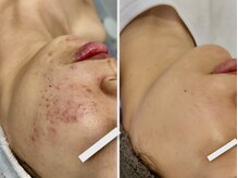 サロン ド ビューティージュエル(salon de beauty JEWEL)の雰囲気(【毛穴開き・汚れ/凹凸肌/赤ニキビケア】プラズマニア!)