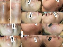 ヴィクシア(VIXIA)の雰囲気（徹底した肌管理！お任せください◎ニキビシミ毛穴）