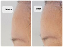 ムー ブランチ(Mou Branch)/ACトリートメント