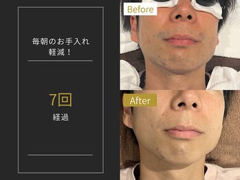 ステイゴールド 新百合ヶ丘(STAY GOLD)/おヒゲ脱毛の経過☆