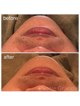 ビューティーモール(BEAUTY MALL)/効果を実感できる光脱毛1回施術