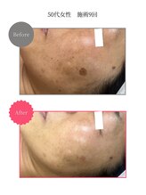 ボータン 恵(Beau Temps)/ウルトラ光トーニング/シミ改善