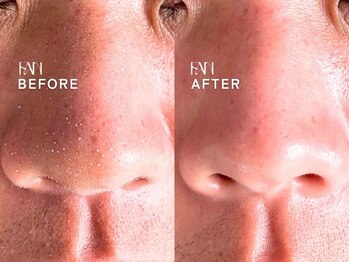 ファン(FAN)/いちご鼻改善★毛穴スッキリ