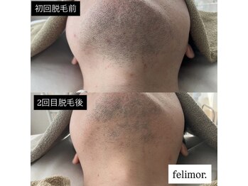 フェリモール(Felimor.)/メンズ脱毛