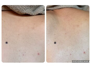 アルマ(ALMA)/背中もマツヤニ