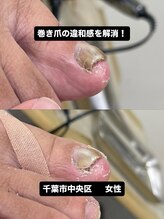 巻き爪じゅん 千葉駅前店/巻き爪の痛みを根本からケア