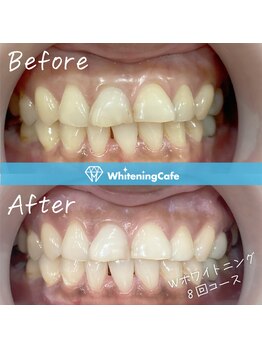 ホワイトニングカフェ 平塚店(WhiteningCafe)/◎歯のホワイトニング施術写真◎