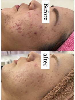 ルヴィ うるま店(REVI)/REVIハーブピーリング