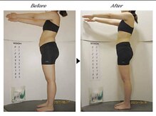 ビューティークリニックコダマ 都城店/【2ヶ月コース】A.K様(21歳)