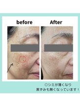 サロン ド ブリオン(Salon de Brillant)/シミにもアプローチ