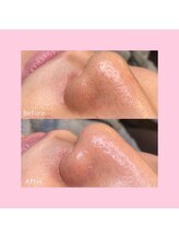 ホワイトラボ 新潟万代(White labo)/【施術例】ハイドロフェイシャル