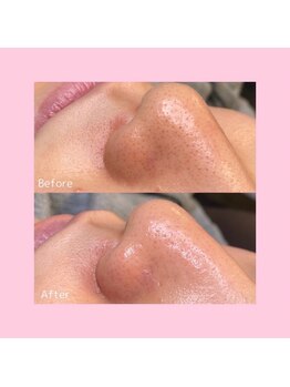 ホワイトラボ 新潟万代(White labo)/【施術例】ハイドロフェイシャル