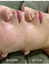 サロンドジェシカ(salon de Jessica)/プラズマ＋ハーブピーリング