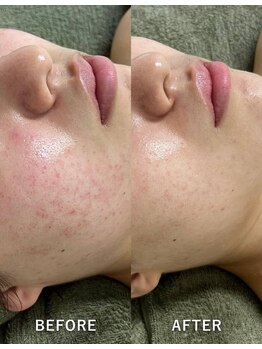 サロンドジェシカ(salon de Jessica)/プラズマ＋ハーブピーリング