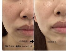 メディカルサロンドオフ 堺東店(medical salon de off)/LEZE(ルゼ)基礎ピーリング