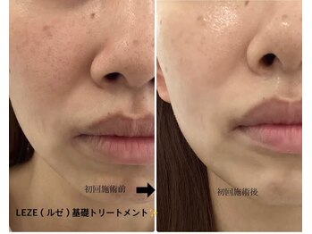 メディカルサロンドオフ 堺東店(medical salon de off)/LEZE(ルゼ)基礎ピーリング