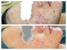 ハーブに力でどんな肌でも劇的変化させます！！