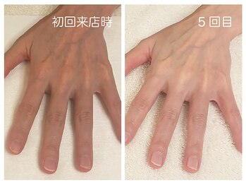 キレイテ 福岡天神店/くすみとゴワつき