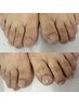 【足の深爪】夏にサンダルを履きましょう!足の深爪矯正キャンペーン!