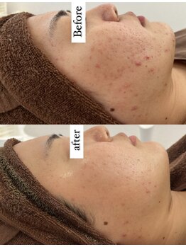 ルヴィ うるま店(REVI)/REVIハーブピーリング