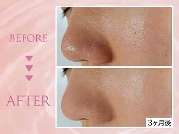 クリアラボ 上野(Clear Lab)/韓国肌管理&毛穴洗浄専門店