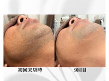 アン ビューティー(ann beauty)の雰囲気（【メンズ】最新美肌ヒゲ脱毛♪広範囲　9回目）