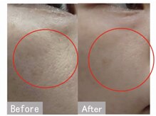 エン(O'en)/ヒト幹細胞炭酸パック