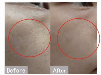 エン(O'en)/ヒト幹細胞炭酸パック