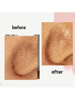 アクアビューティ ミヨン(Aqua beauty MIYON)/毛穴洗浄(beauty &nbsp;after)