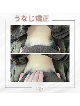 ミース 自由が丘店/うなじ矯正◆ビフォーアフター