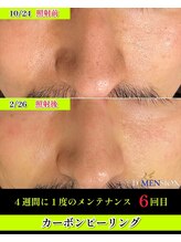 ディメンション 新宿(DiMENSION)/カーボンピーリング☆メンズ脱毛