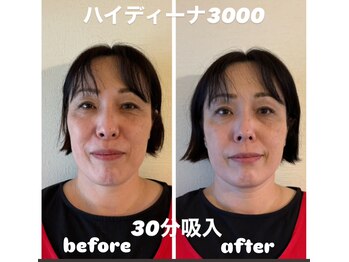 ヨサパーク メリー(YOSA PARK merry)/ハイデイーナ3000吸入