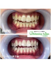 ホワイトニングサロン 名古屋駅店/【ホワイトニング施術例】