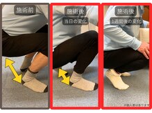 まこと整骨院/ひざ関節症の痛み改善例