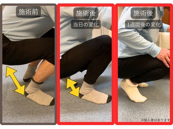 まこと整骨院/ひざ関節症の痛み改善例
