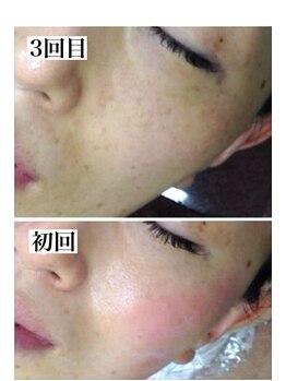 エメ(Aimer)/ハーブトリートメント