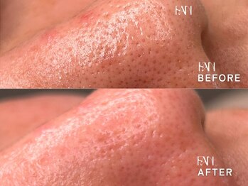 ファン(FAN)/いちご鼻改善★毛穴スッキリ