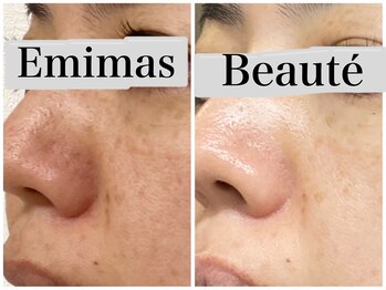 エミマス ボーテ(Emimas Beaute’)/４０代 幹細胞＆毛穴洗浄
