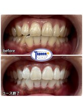 ティースペース 蒲郡店(T-space)/クリスタルWhite Plus