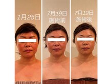 アンリール(ANRIRE)の雰囲気（リンパボーラーとゼロジーフリー月1回&ホームケア小顔に変化◎）