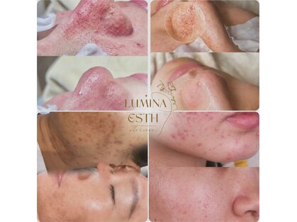ルミナエステ(LUMINA ESTH)の写真