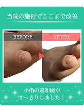 フルフィル 高田馬場店/副爪（小指横の角質）ケア