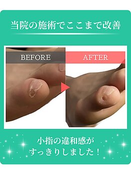 フルフィル 高田馬場店/副爪(小指横の角質)ケア